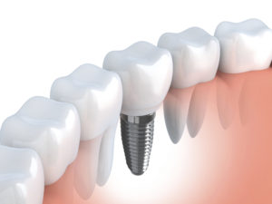 How Dental Implants Can Help You
